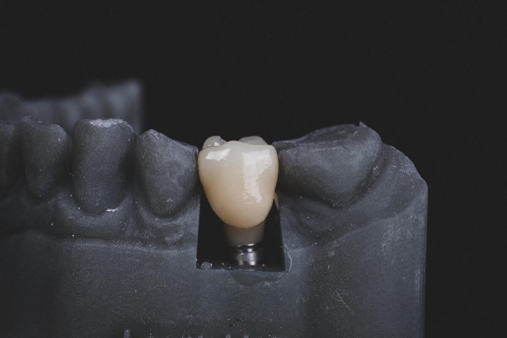Tooth implant to demonstrate Tidens tand